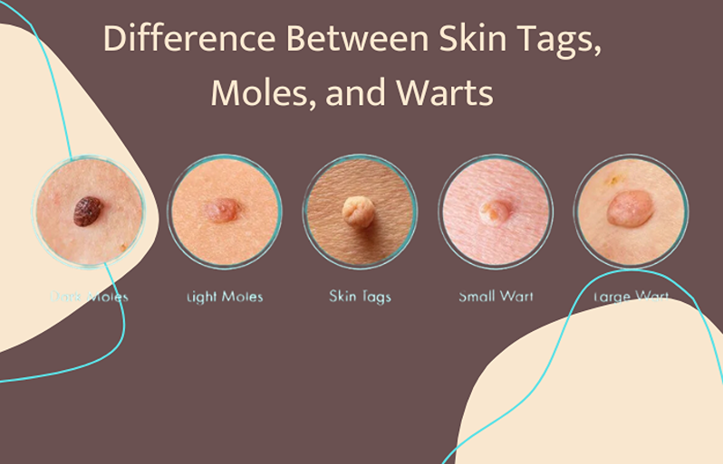 difference skin tags warts moles